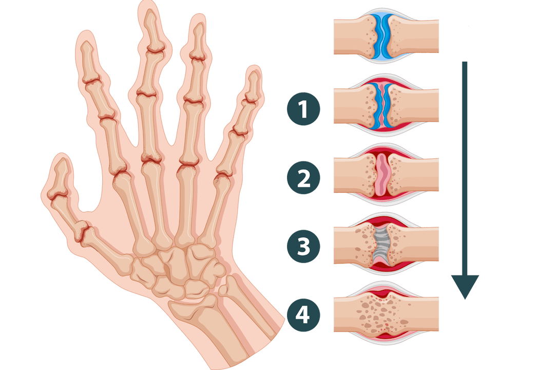 Stages of development of arthritis - inflammatory damage of the joints