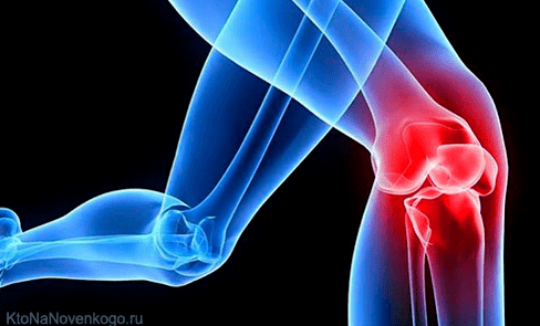 Arthritis