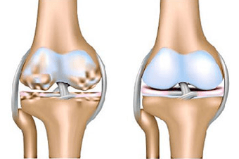 Healthy joint and arthritis
