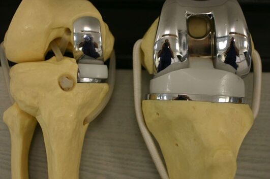 Variations of the endoprostable knee joint