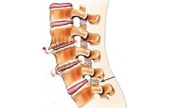 spondylarm as causes of back pain