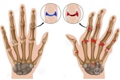 The causes of finger joint pain