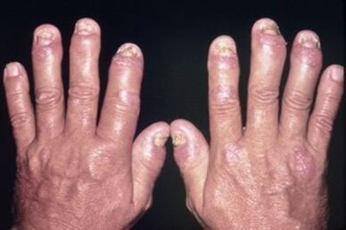 Why finger joints hurt