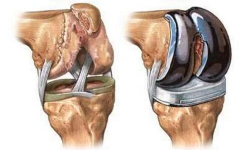 Untoprotherapy of the knee joint for arthritis