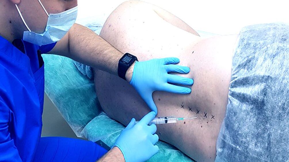 Spinal block for osteochondria