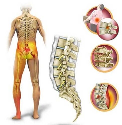Osteochondrosis of the lumbar spine, causing low back pain