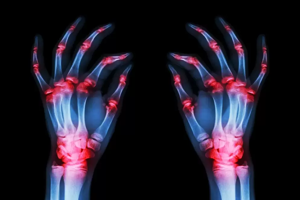 joints of the finger joints