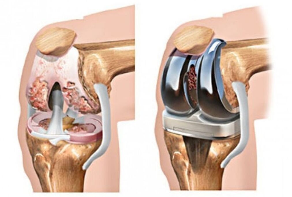 knee arthroplasty for joints