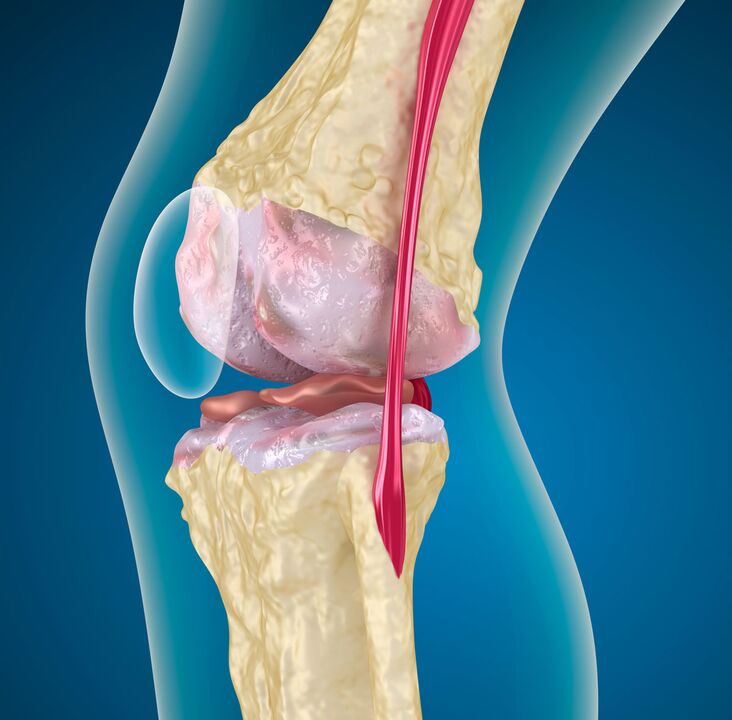 Arthropathy of the knee joint - a degenerative-dystrophic disease