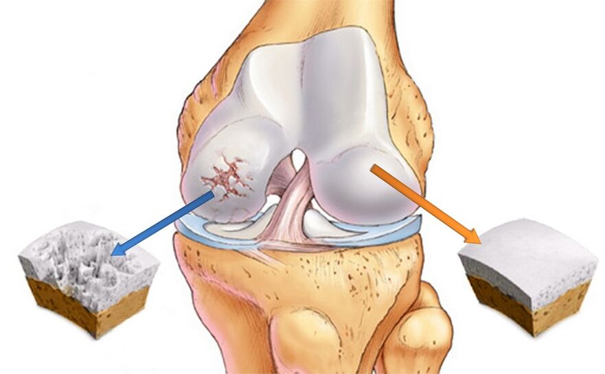 Healthy knee joint (right) and affected by arthropathy (left)