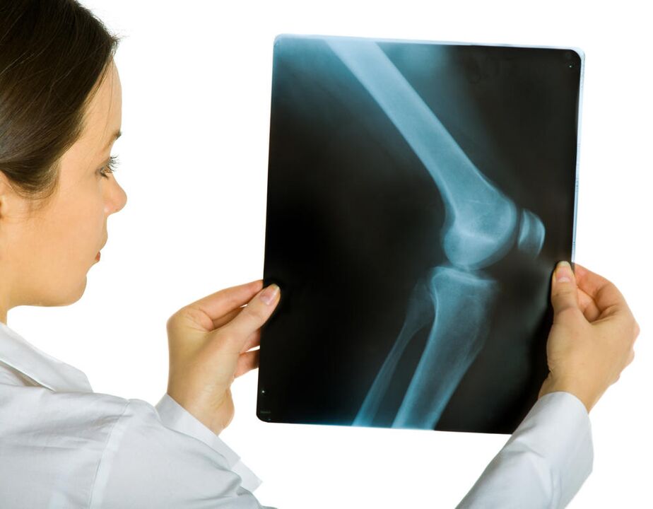 X-ray of the knee joint will reveal the presence of deforming arthropathy